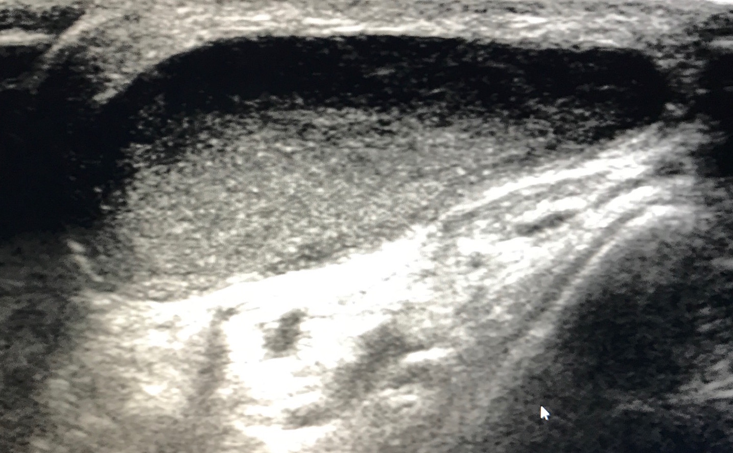 Figure 4 for case synovial sarcoma ( RID4558 ) of the ankle